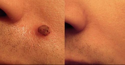 Customer photo review of CC™ Tags & Moles Remover