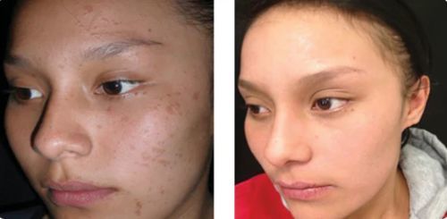 Customer photo review of CC™ Instant Tags & Moles Removal Gel