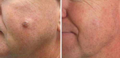 Customer photo review of CC™ Tags & Moles Remover