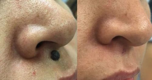 Customer photo review of CC™ Instant Tags & Moles Removal Gel