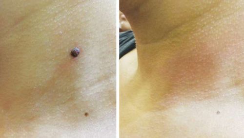 Customer photo review of CC™ Tags & Moles Remover