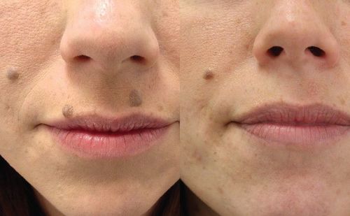 Customer photo review of CC™ Instant Tags & Moles Removal Gel