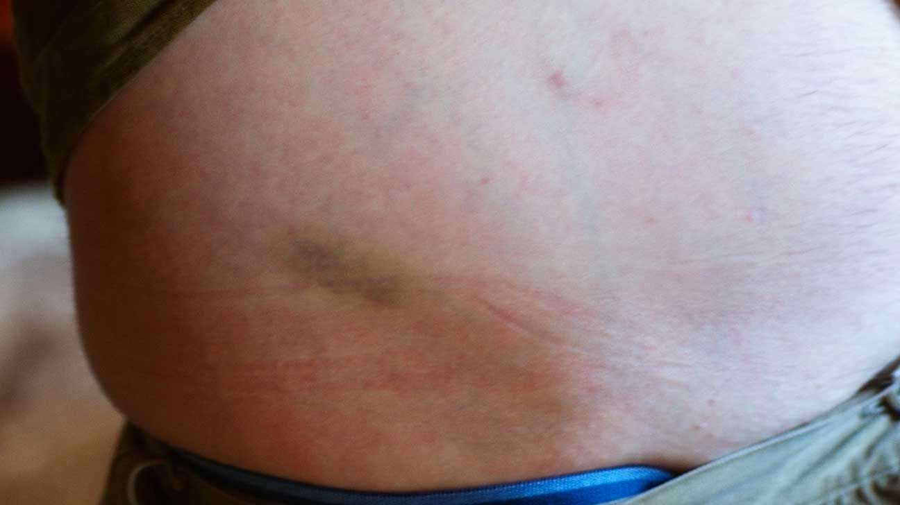 Customer photo review of BD Micro-Fine 31G 8mm hgh needles