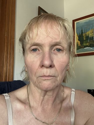 Customer photo review of EvenSkyn® Lumo: Premium Anti-Aging & Skin Tightening Handset