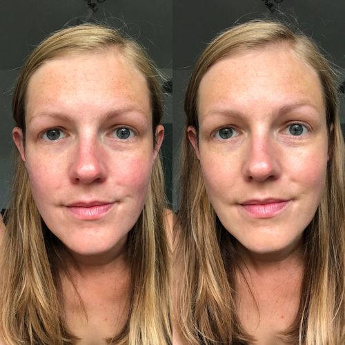 Customer photo review of Rosalique 3 in 1 Anti-Redness Miracle Formula SPF50
