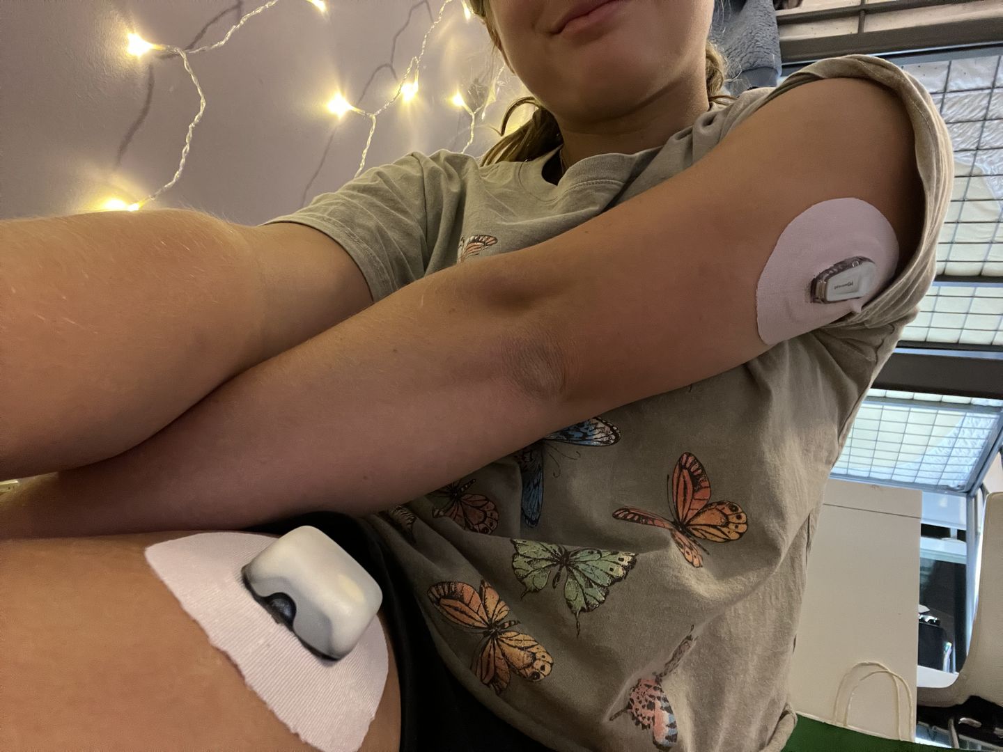 Customer photo review of Skin Grip Original - Omnipod Adhesive Patches