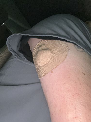 Customer photo review of Skin Grip Original - Medtronic Guardian/Enlite Adhesive Patches