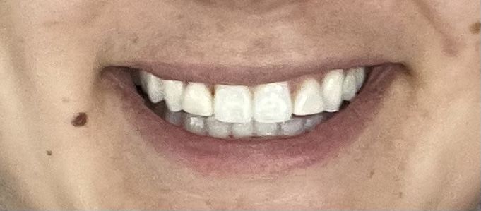 Customer photo review of Bandes Blanchissantes PAP (sans peroxyde)