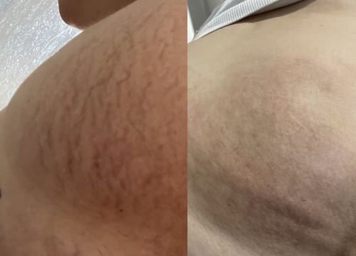 Customer photo review of *NEW* Dr. Pen A9 Microneedling Pen