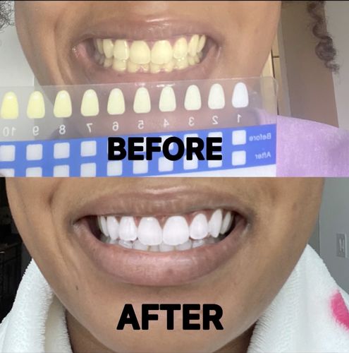 Customer photo review of Polar MD Teeth Whitening Kit