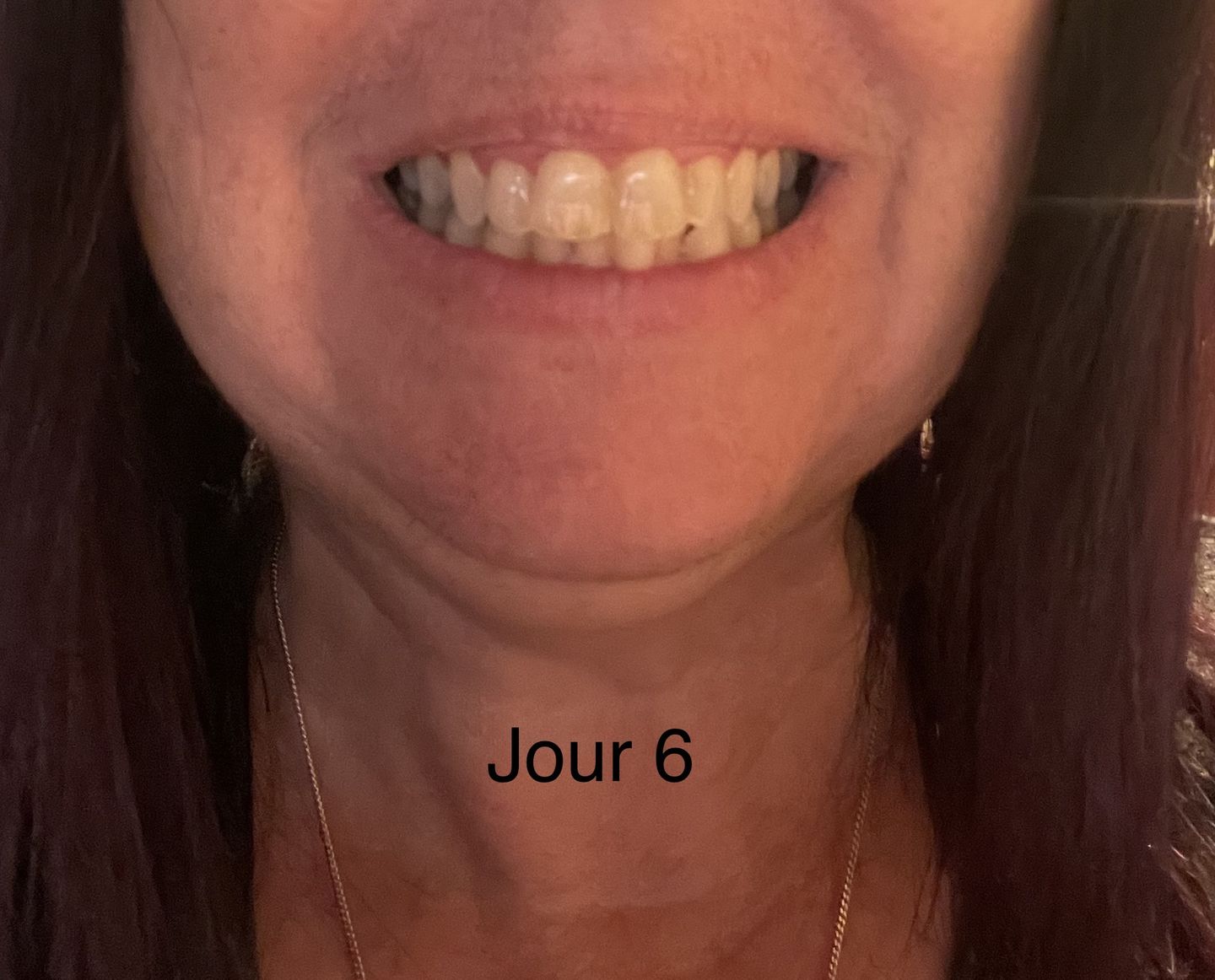 Customer photo review of Bandes Blanchissantes PAP (sans peroxyde)