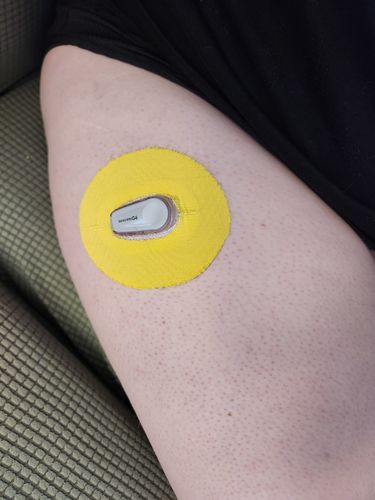 Customer photo review of Skin Grip Original - Dexcom G6 Patches