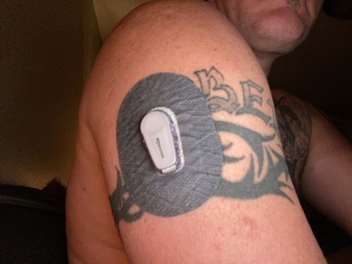 Customer photo review of Skin Grip MAX Dexcom G6 Patches