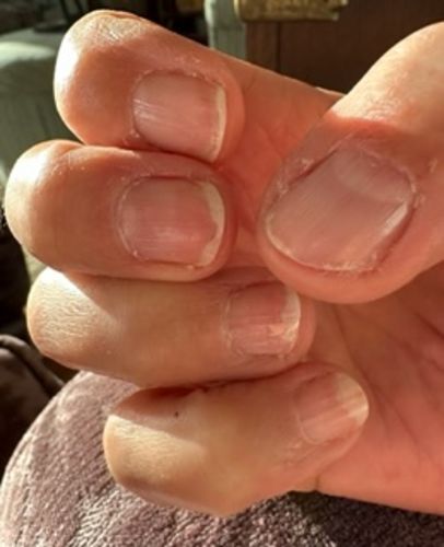 Customer photo review of Rocket Nail Fuel Nail Repair - Clear