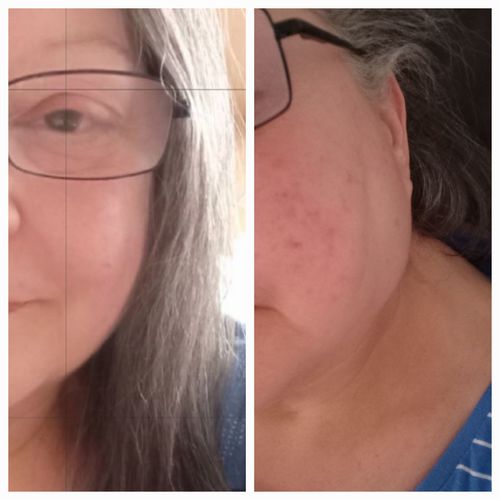 Customer photo review of Rosalique 3 in 1 Anti-Redness Miracle Formula SPF50 Sample 3ml