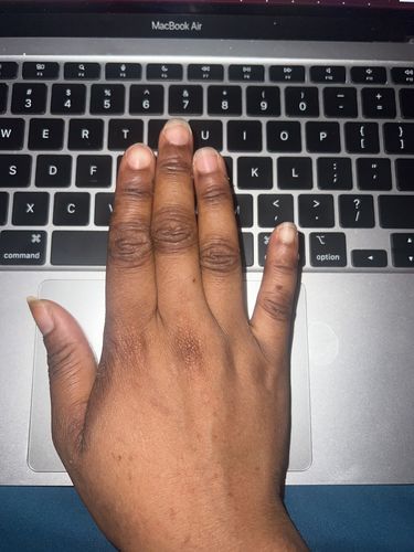 Customer photo review of Knuckle serum (removes dark knuckles)