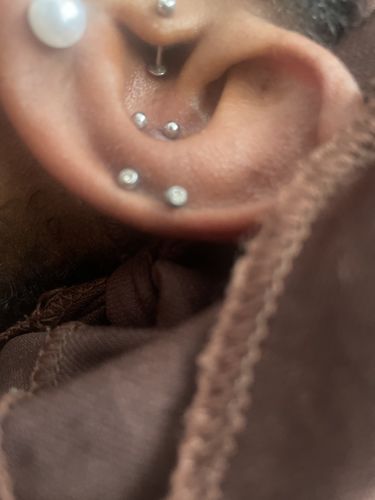 Customer photo review of Piercing Bump Treatment - Bump, Keloid & Scar Relief Oil