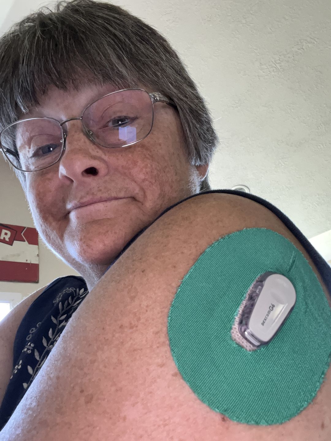 Customer photo review of Skin Grip Original - Omnipod Adhesive Patches