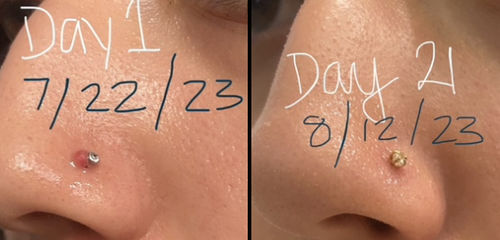 Customer photo review of Piercing Bump Treatment - Bump, Keloid & Scar Relief Oil