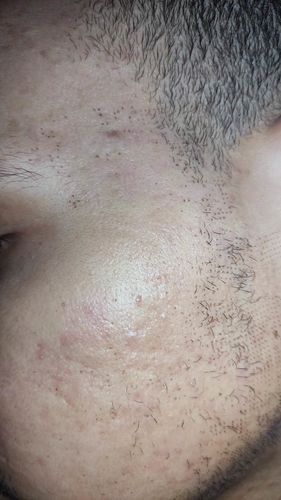 Customer photo review of Pack Anti-Imperfections