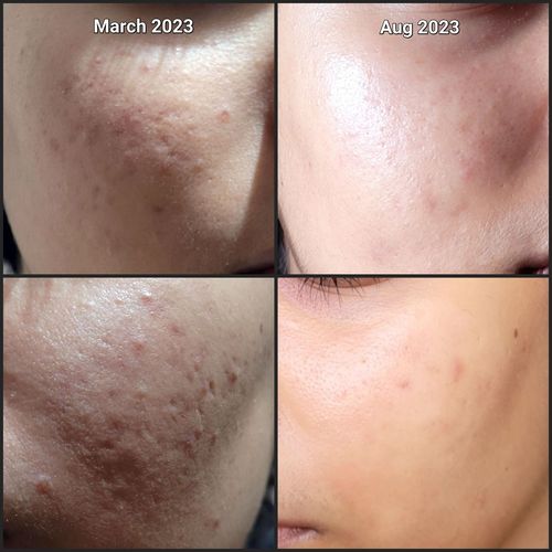 Customer photo review of 10% Vitamin C Serum | Radiance Booster | Peptide Complex & Ferulic Acid