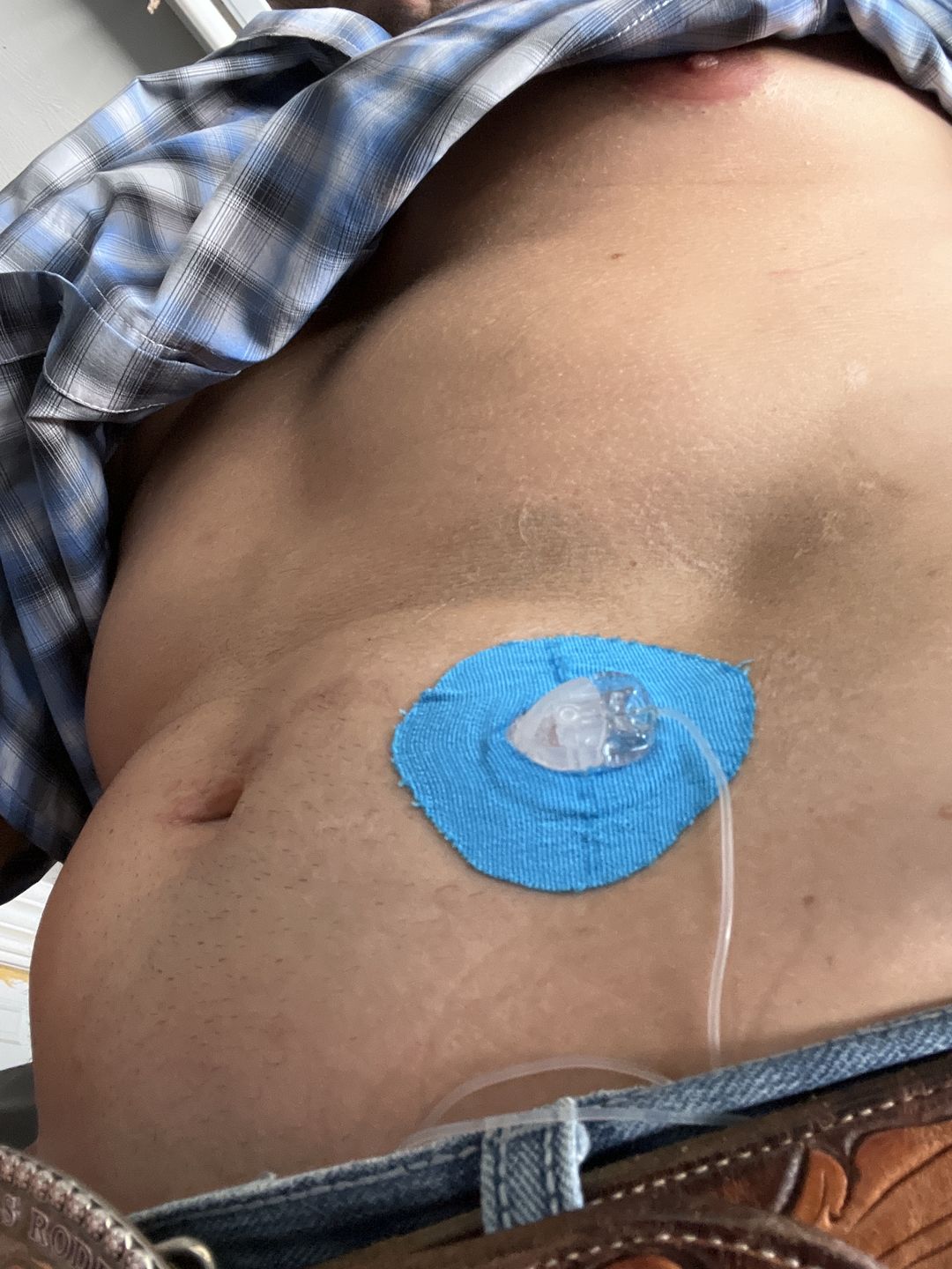 Customer photo review of Skin Grip Original - Universal Adhesive Patches (0.8 inch Hole)