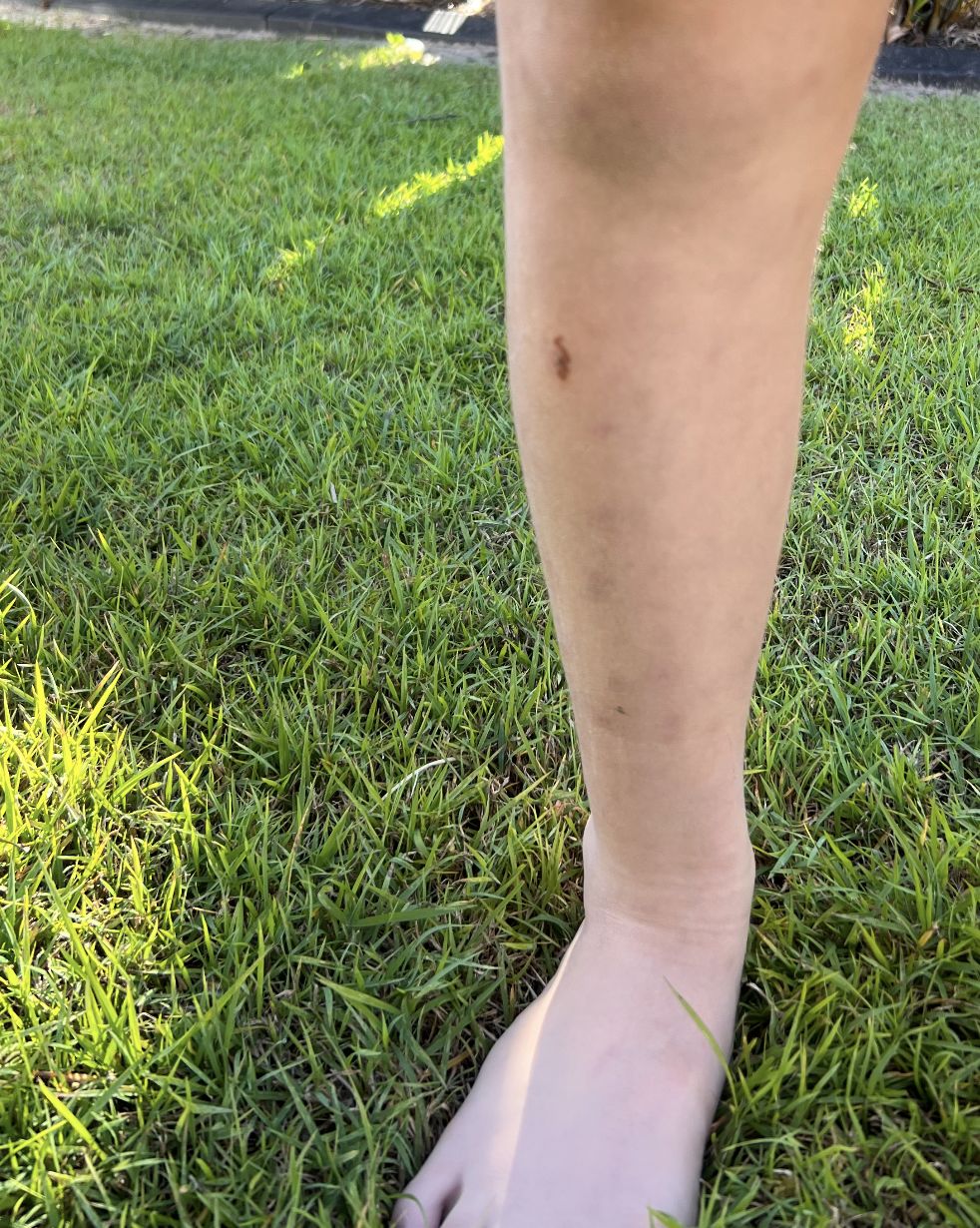 Customer photo review of Mozzie Patch Natural Repellent