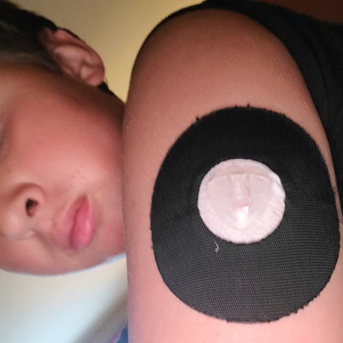 Customer photo review of Skin Grip Original - Freestyle Libre/Pump Adhesive Patches