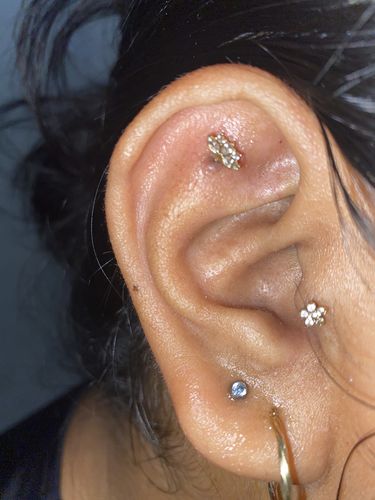Customer photo review of Piercing Bump Treatment - Bump, Keloid & Scar Relief Oil