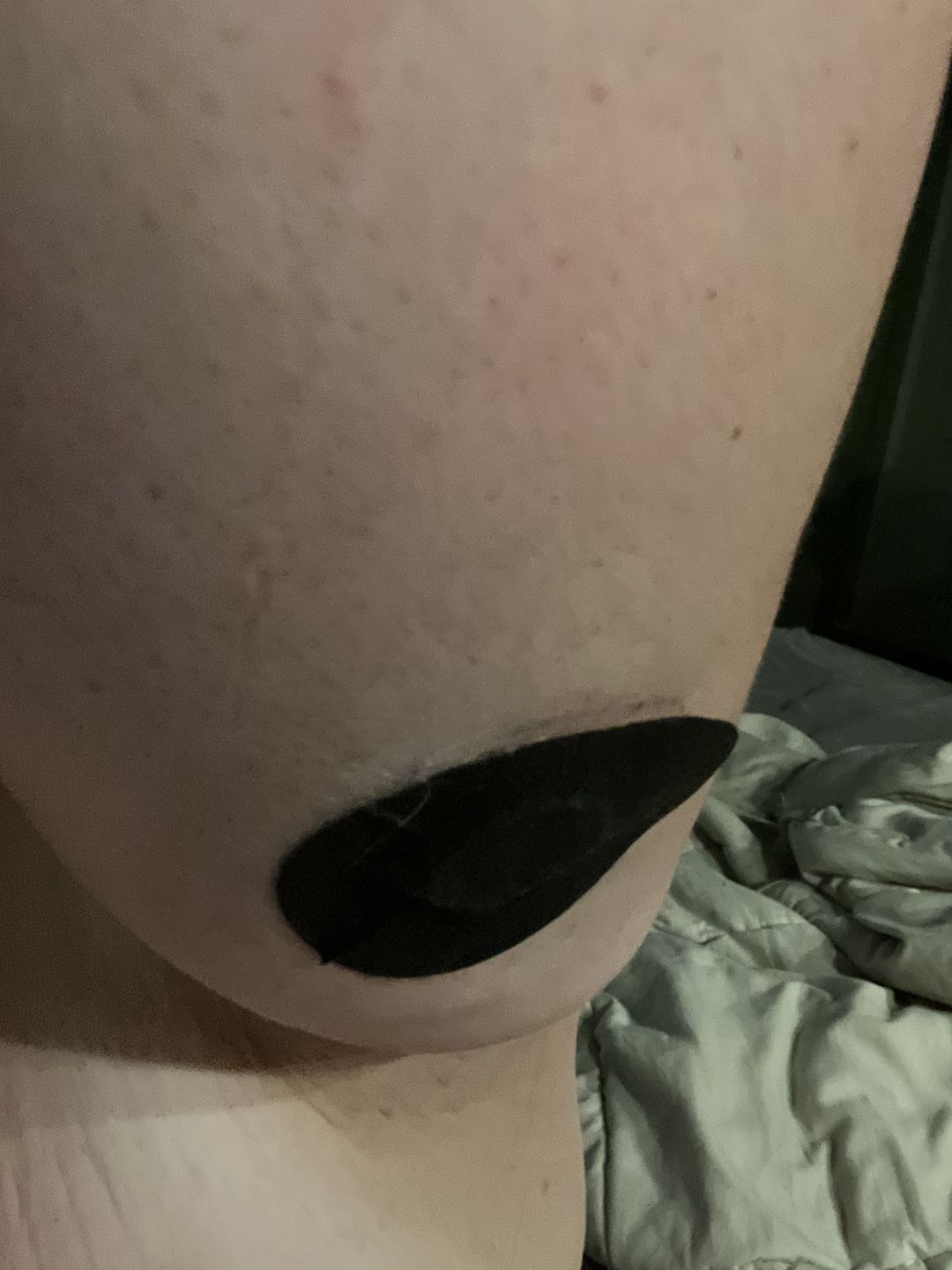 Customer photo review of Skin Grip MAX Freestyle Libre Patches