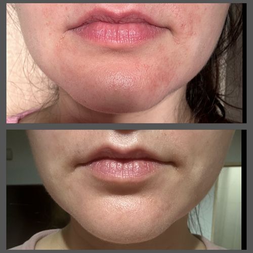 Customer photo review of RUTINA DERMATITIS SEBORREICA