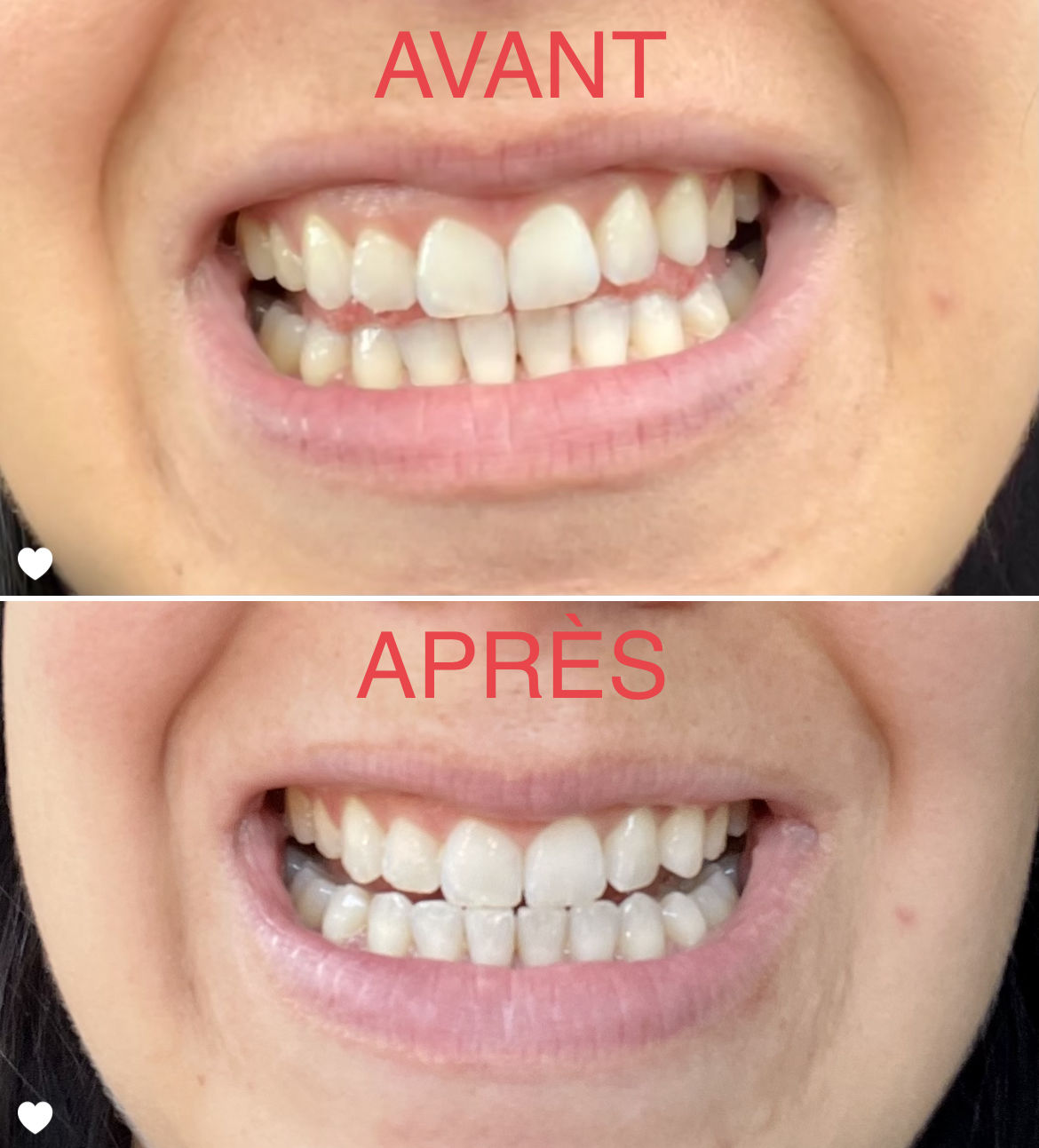 Customer photo review of Bandes Blanchissantes PAP (sans peroxyde)