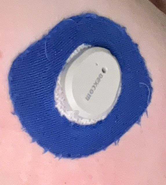 Customer photo review of Skin Grip Original - Dexcom G7 Adhesive Patches (With Hole)