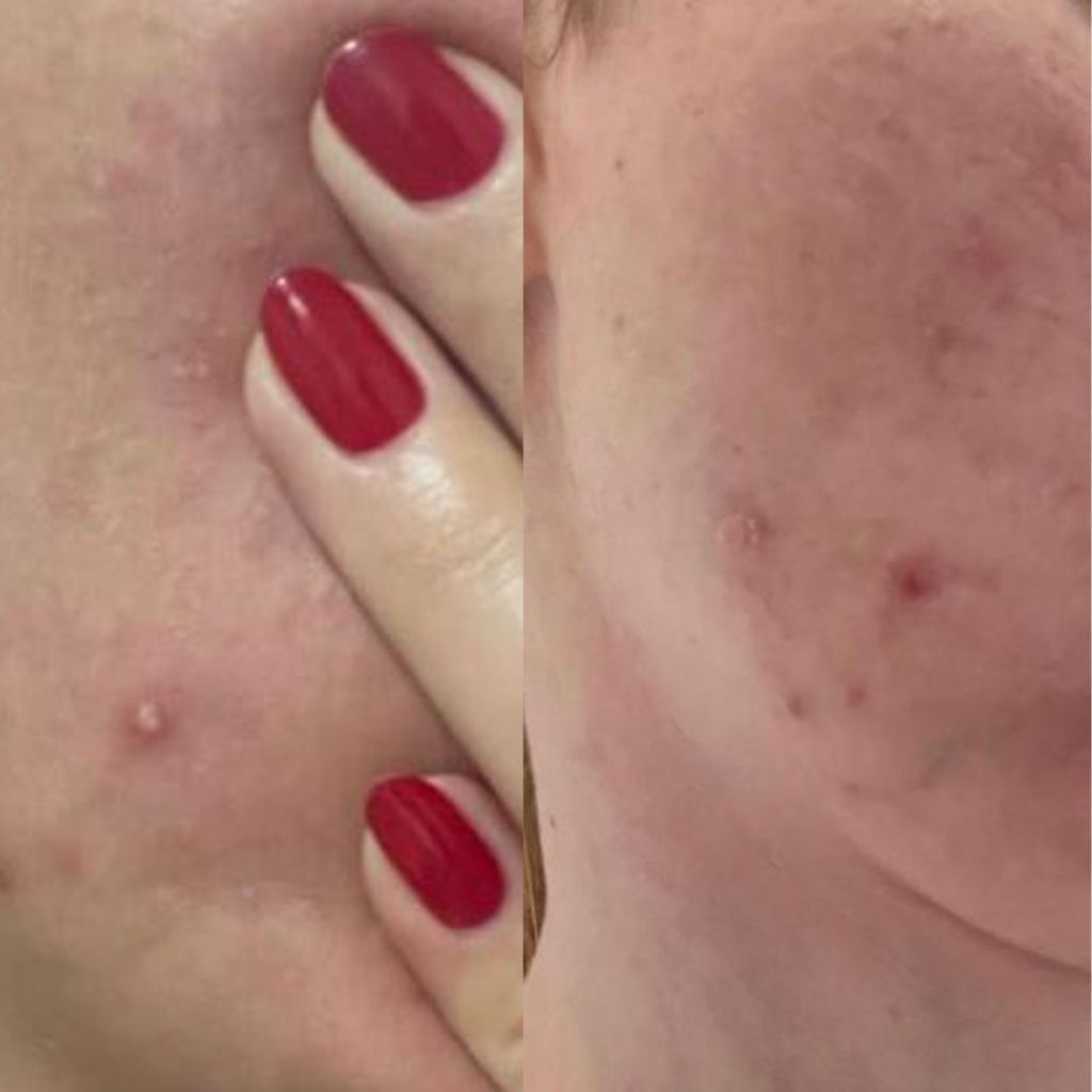 Customer photo review of HaloSkin Day & Night Patches