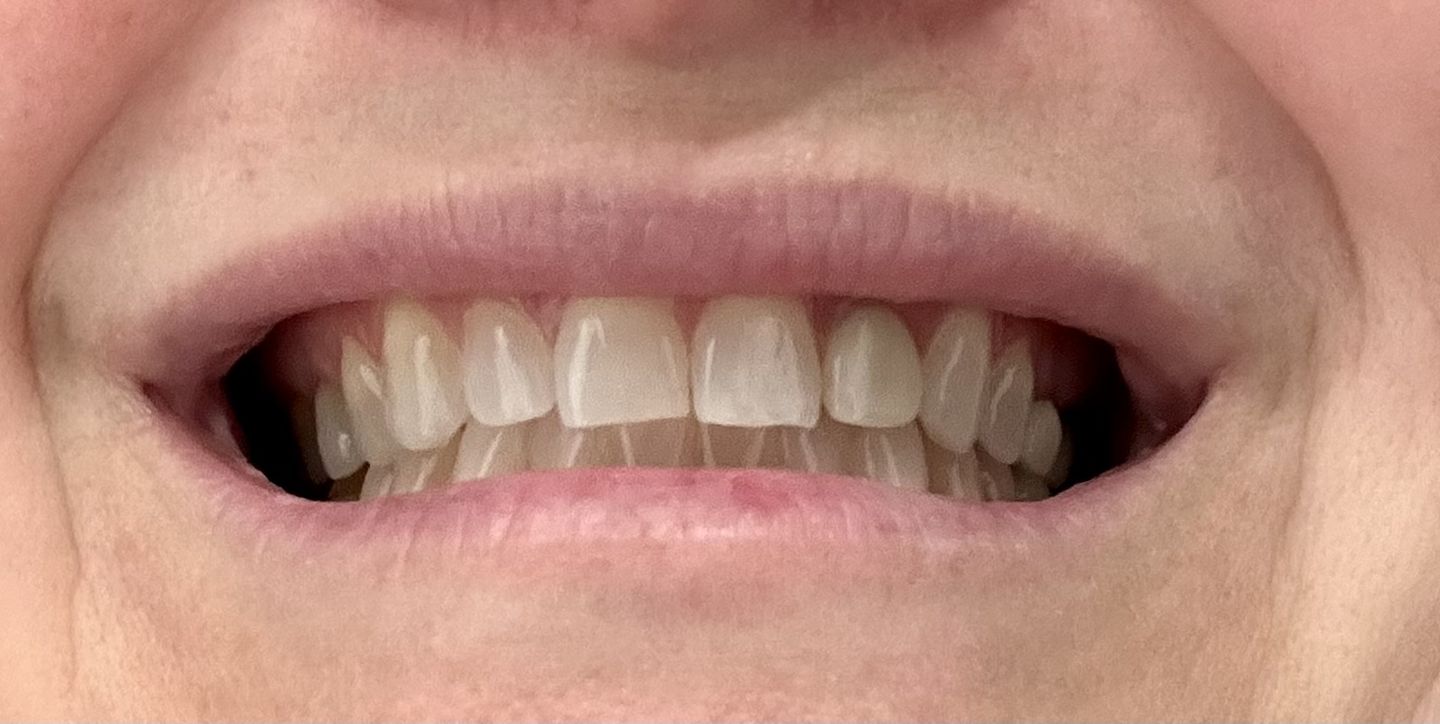 Customer photo review of Bandes Blanchissantes PAP (sans peroxyde)