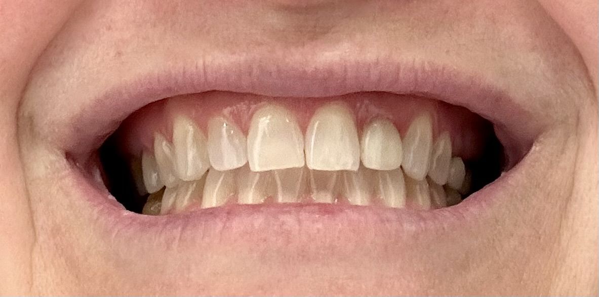 Customer photo review of Bandes Blanchissantes PAP (sans peroxyde)
