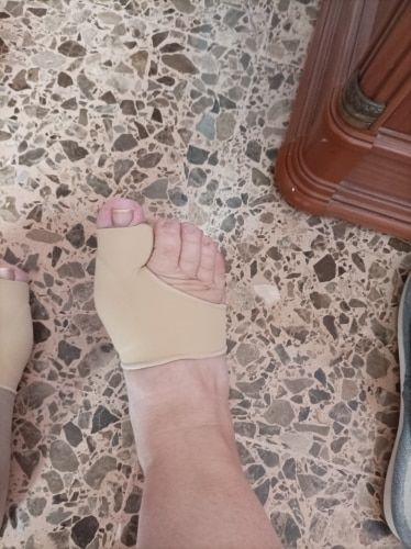 Customer photo review of Bunion Corrector - Toe Separator and Corrector
