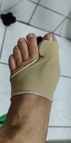 Customer photo review of Bunion Corrector - Toe Separator and Corrector