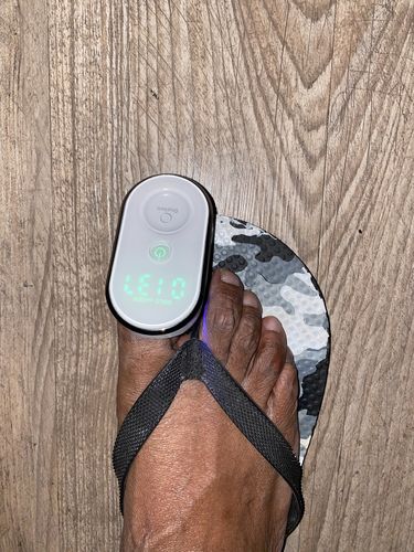 Customer photo review of Onychom - Antifungal Laser Device