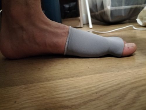 Customer photo review of Bunion Corrector - Toe Separator and Corrector