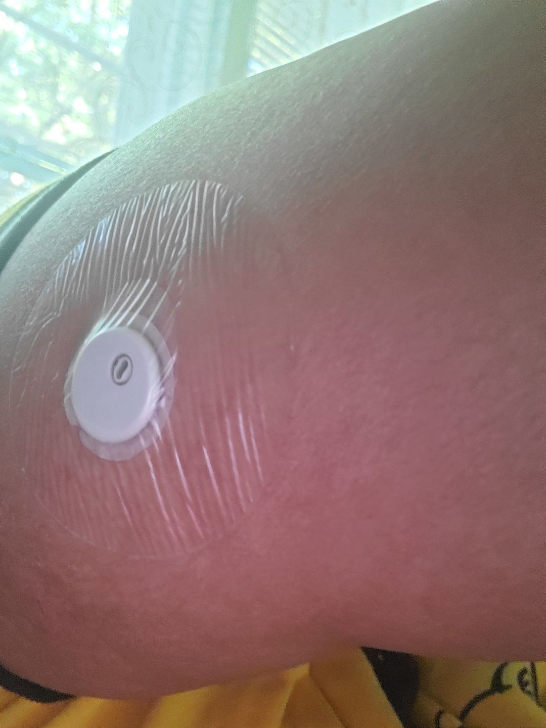 Customer photo review of Skin Grip Original - Freestyle Libre Adhesive Patches