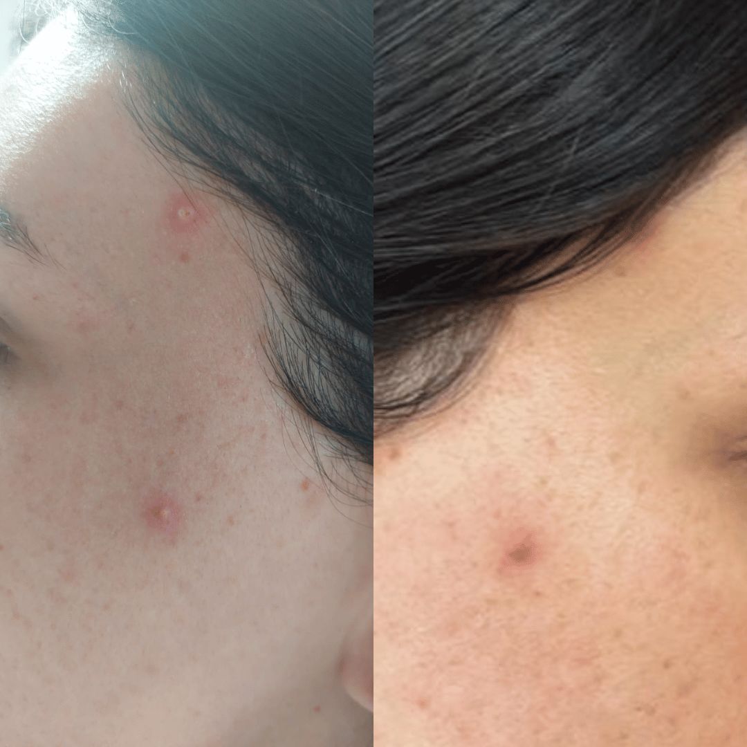 Customer photo review of HaloSkin Day & Night Patches