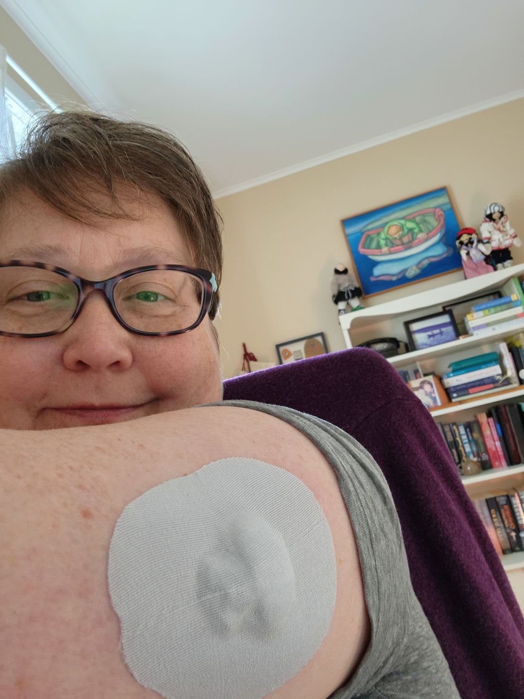 Customer photo review of Skin Grip Original - Medtronic Guardian/Enlite Adhesive Patches