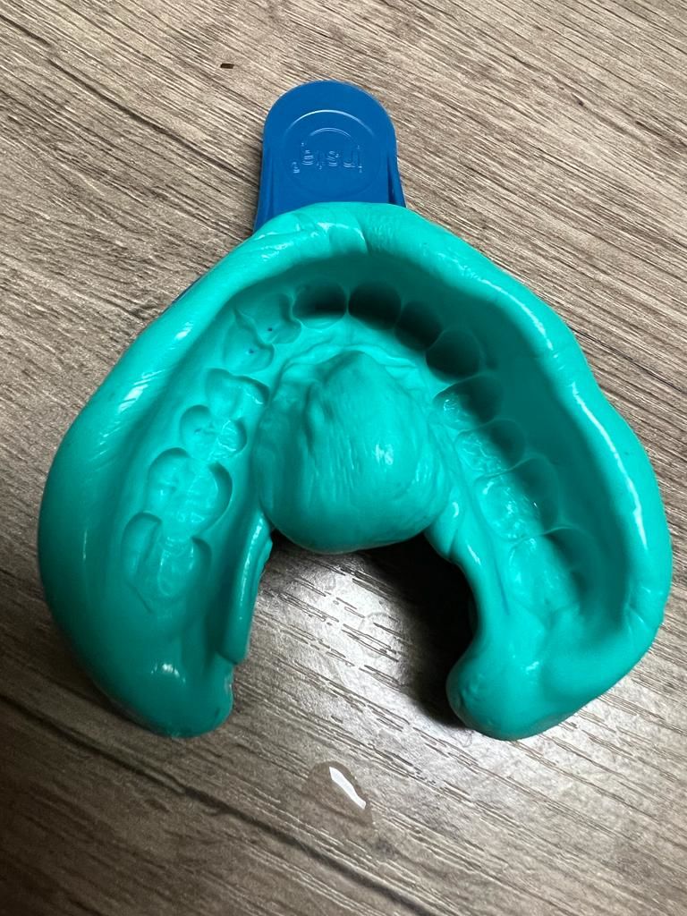 Customer photo review of 2mm Hard Night Guard - Custom Night Guard For Moderate Teeth Grinding/Clenching