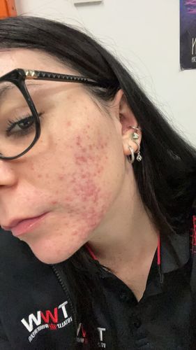 Customer photo review of Intermediate Acne Program™