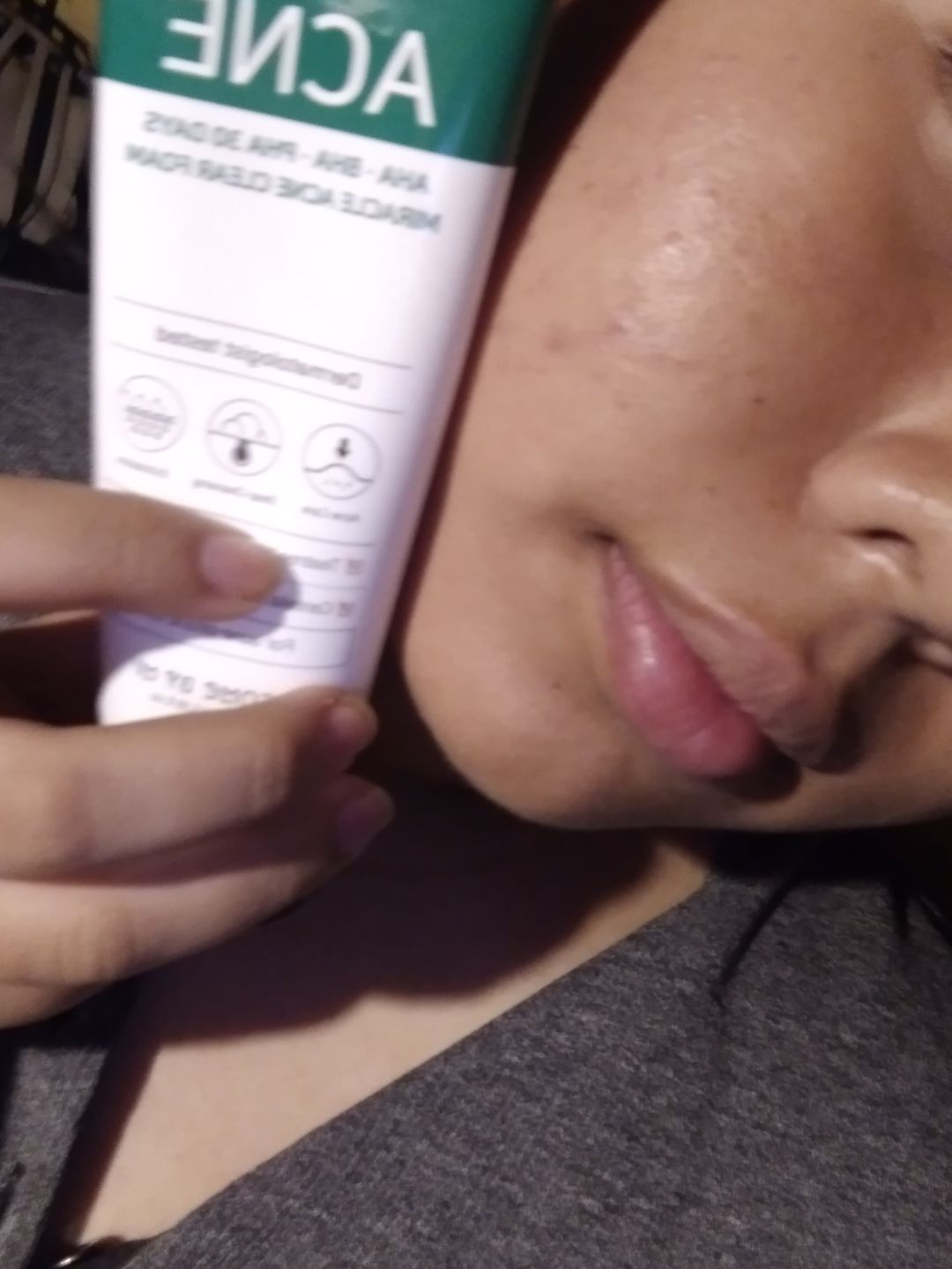 Customer photo review of AHA-BHA-PHA 30 Days Miracle Acne Clear Foam - 100ml