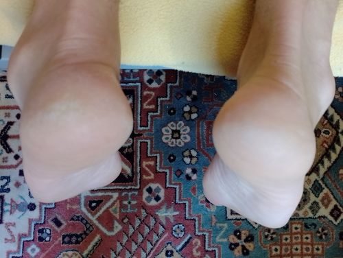 Customer photo review of LOVASKIN INSTANT FOOT PEEL Deluxe Kit - Less than 3.20 per treatment