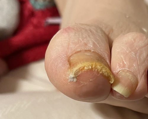 Customer photo review of Antifungal Laser Enhancer