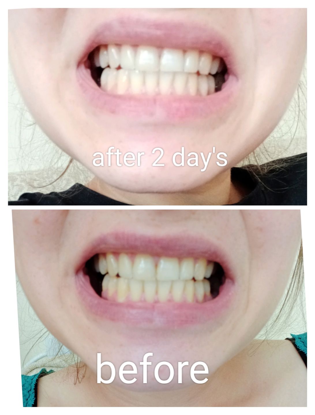 Customer photo review of Teeth Whitening Kit