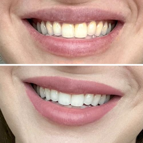 Customer photo review of Polar MD Teeth Whitening Kit